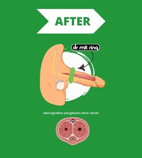 Ilustrasi perubatan dengan Dr. MIT Ring di pangkal: aliran darah keluar diperlahankan